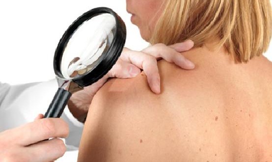 Euromelanoma day, anche i dermatologi perugini aderiscono alla campagna di prevenzione