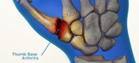 La rizoartrosi o artrosi del pollice